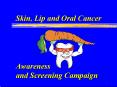 Skin, Lip and Oral Cancer PowerPoint PPT Presentation