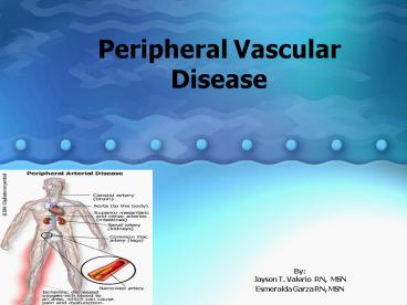 Peripheral Vascular Disease