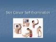 Skin Cancer SelfExamination PowerPoint PPT Presentation