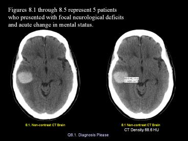 8.1. Non-contrast CT Brain