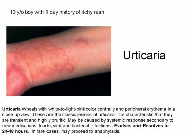Urticaria