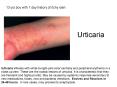 Urticaria PowerPoint PPT Presentation
