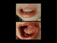 What is the difference between HSV-1 and HSV-2?