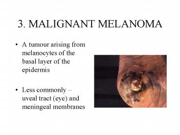 3. MALIGNANT MELANOMA