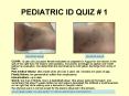 PEDIATRIC ID QUIZ PowerPoint PPT Presentation