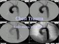 Chest Trauma PowerPoint PPT Presentation
