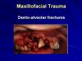Maxillofacial Trauma Dentoalveolar fractures PowerPoint PPT Presentation