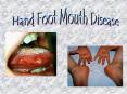 Hand Foot Mouth Disease PowerPoint PPT Presentation