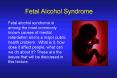 Fetal Alcohol Syndrome PowerPoint PPT Presentation