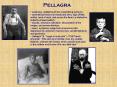 Pellagra PowerPoint PPT Presentation