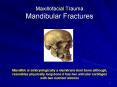 Maxillofacial Trauma Mandibular Fractures PowerPoint PPT Presentation