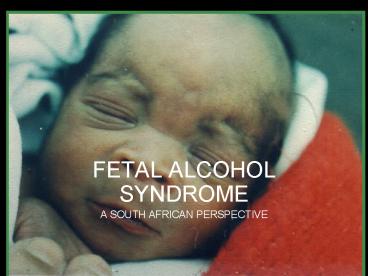 FETAL ALCOHOL SYNDROME