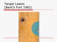 Target Lesion Bents Fort 1982 PowerPoint PPT Presentation