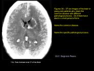 7.3c. PostContrast Axial CT of the Brain