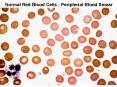 Normal Red Blood Cells Peripheral Blood Smear PowerPoint PPT Presentation