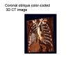 Coronal oblique colorcoded 3D CT image PowerPoint PPT Presentation