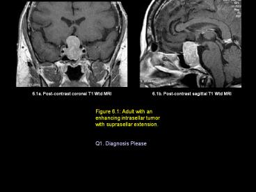 6.1a. Post-contrast coronal T1 Wtd MRI