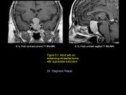 6.1a. Post-contrast coronal T1 Wtd MRI