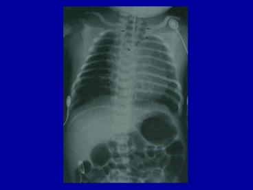 Esophageal Atresia and TEF VACTERL Association