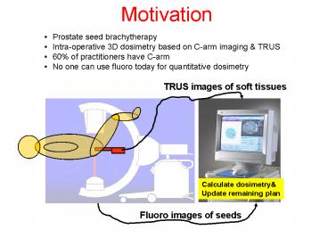 Prostate seed brachytherapy