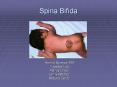 Spina Bifida PowerPoint PPT Presentation