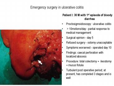 Patient I: 30 M with 1st episode of bloody diarrhea