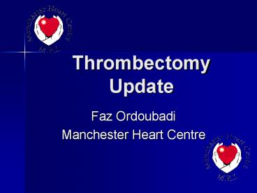 Thrombectomy Update