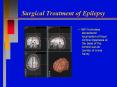 Surgical Treatment of Epilepsy PowerPoint PPT Presentation