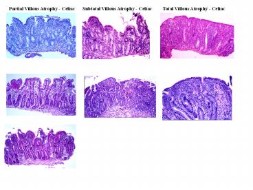 Partial Villous Atrophy - Celiac