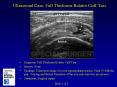 Ultrasound Case: Full Thickness Rotator Cuff Tear PowerPoint PPT Presentation