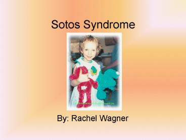 Sotos Syndrome