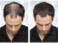 hair transplant in delhi | hair transplant cost in delhi