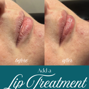 Copy of lip treatment