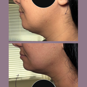 Green and beige minimalist skincare before after collage instagram post