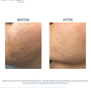 Actual patient  7   details  4 prx derm perfexion   microneedling treatments