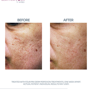 Actual patient  3   details  4 prx derm perfexion treatments