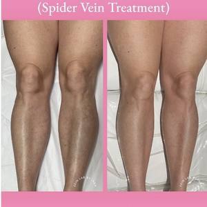 Sclerotherapy before after front