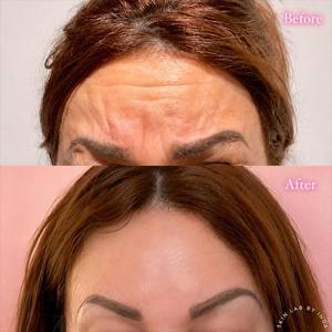Before after forehead salon lofts small