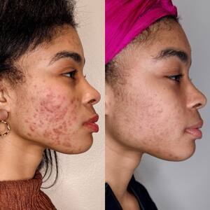 Acne treatment before and after