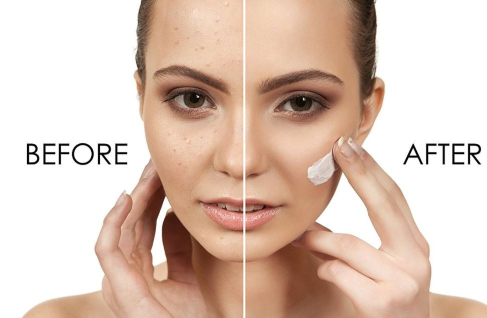 The 4 Best Age Spot Remover You Must Try These! Beauty Over Fifty