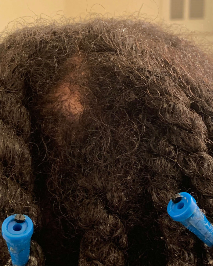bald spot in head