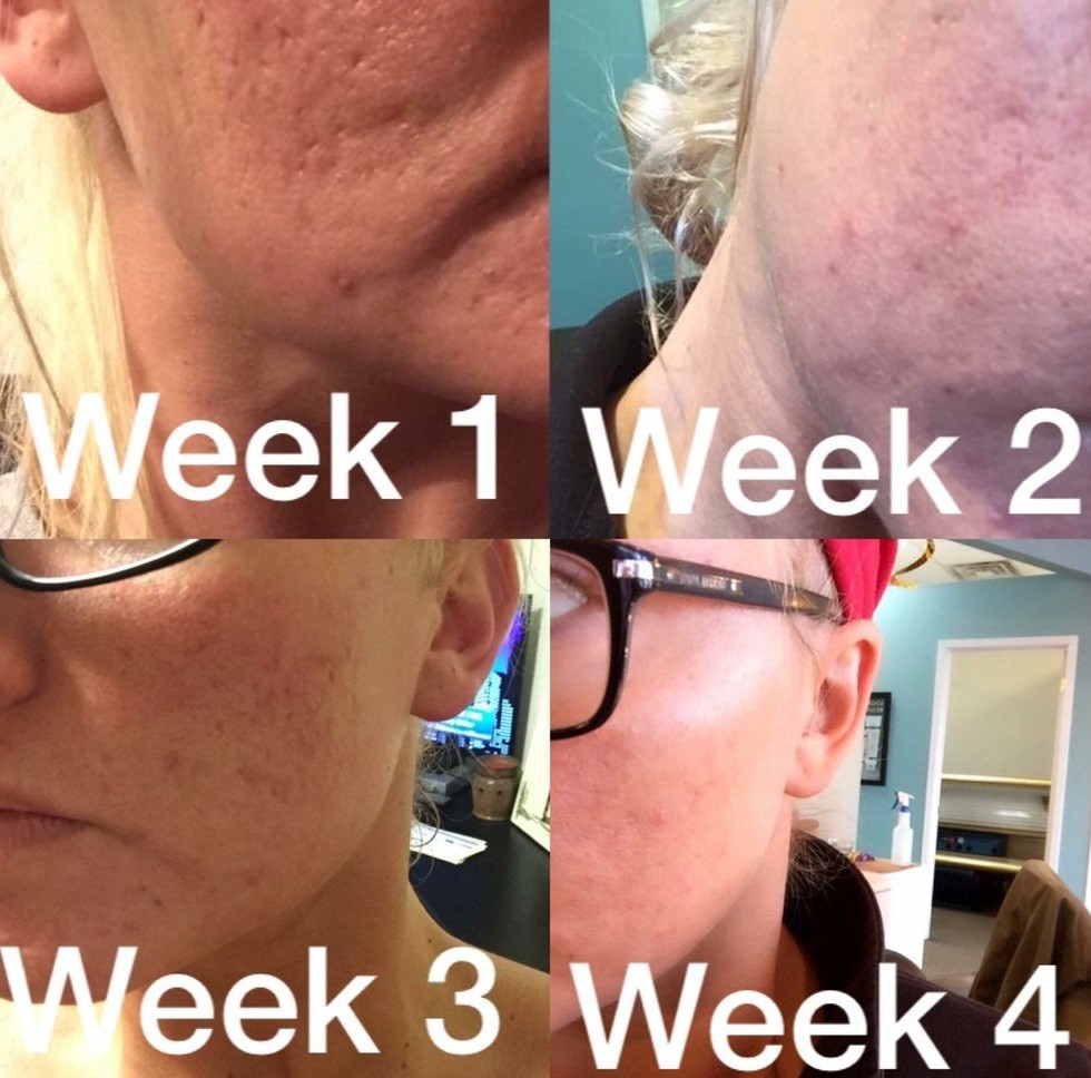 red light therapy results after 4 weeks