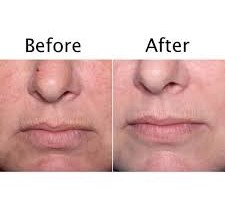 before and after light therapy treatment