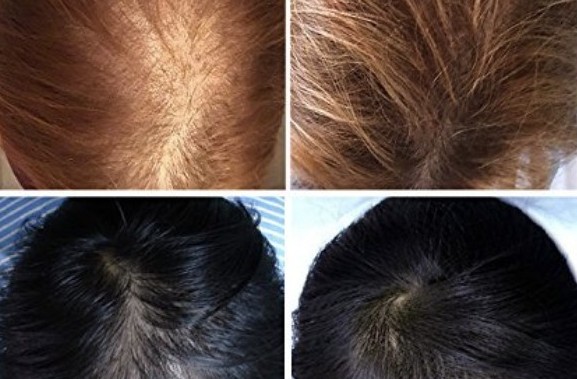 before and after hair treatment pictures