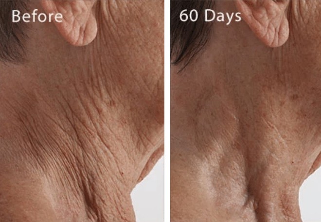 before and after creepy skin treatment using light therapy