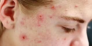 pustules riddled on face