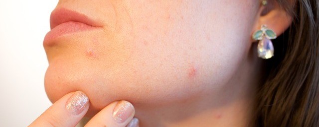whiteheads on face