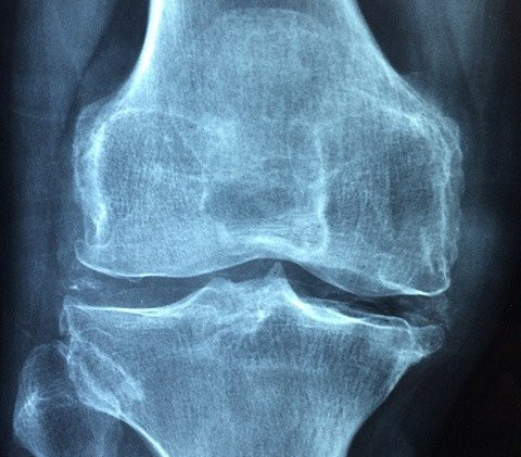 Osteoarthritis
