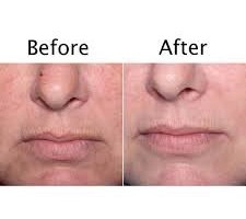 infrared therapy home treatment