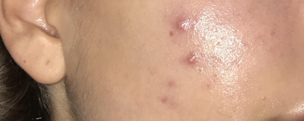 cyst on face
